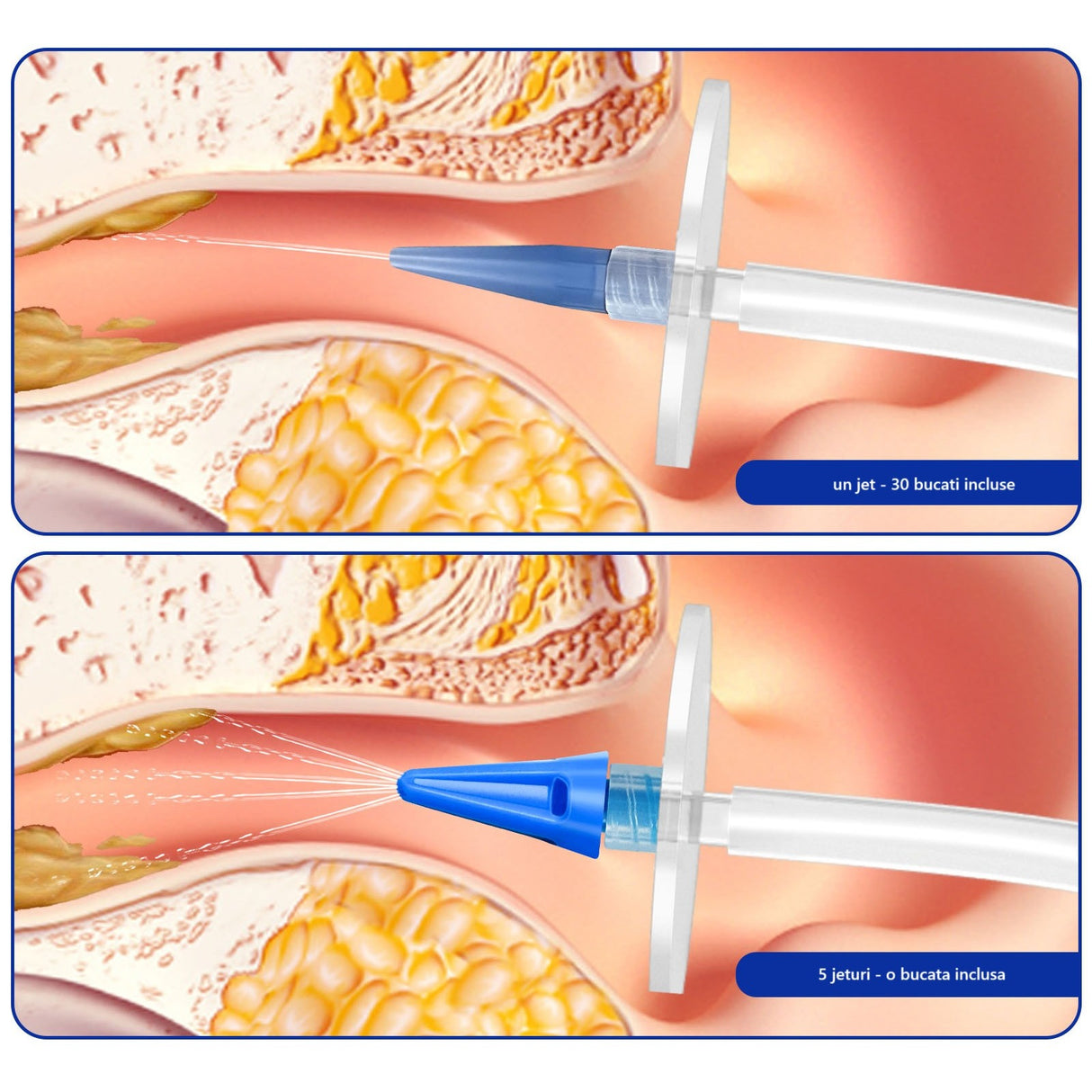 Fültisztító eszköz, fülzsír eltávolításához, tartozékokkal, hasizmokból és PC-ből készült